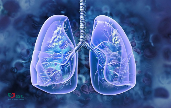Quan niệm sai lầm về ung thư phổi