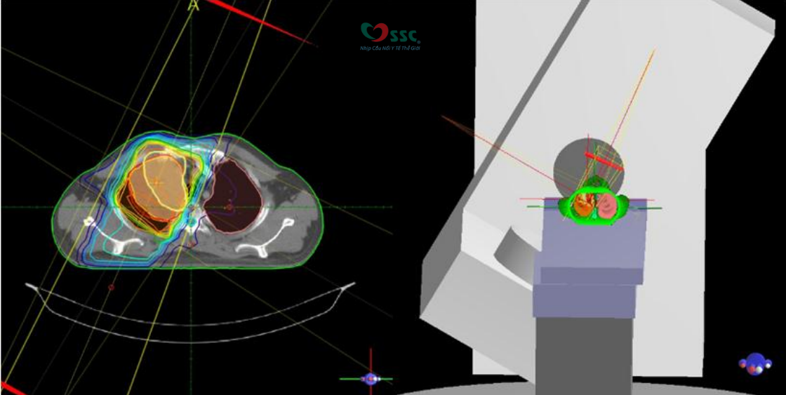 Xạ trị ba chiều (3D) theo hình dạng khối u: Định hình chùm tia phóng xạ bao khít và giảm tổn thương mô bình thường