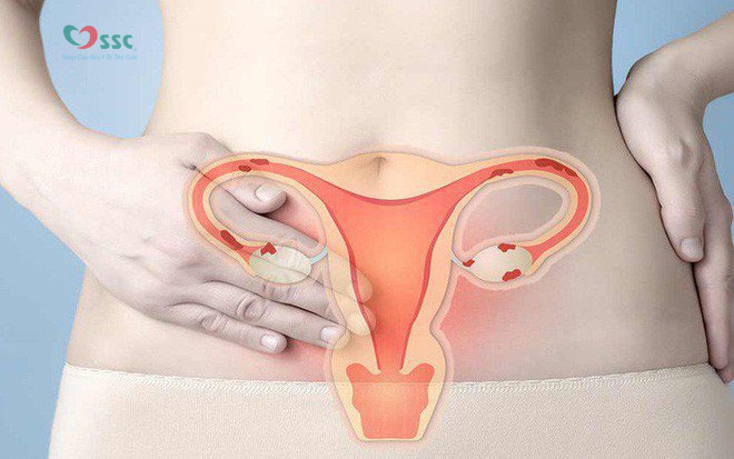 Nội soi tử cung D&C: Quy trình thực hiện và những biến chứng có thể gặp phải