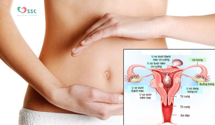 Các giai đoạn ung thư tử cung và phương pháp điều trị tương ứng