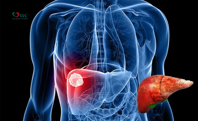 Ung thư gan: Nguyên nhân, triệu chứng và quy trình tầm soát